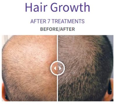 ProcellHairGrowth